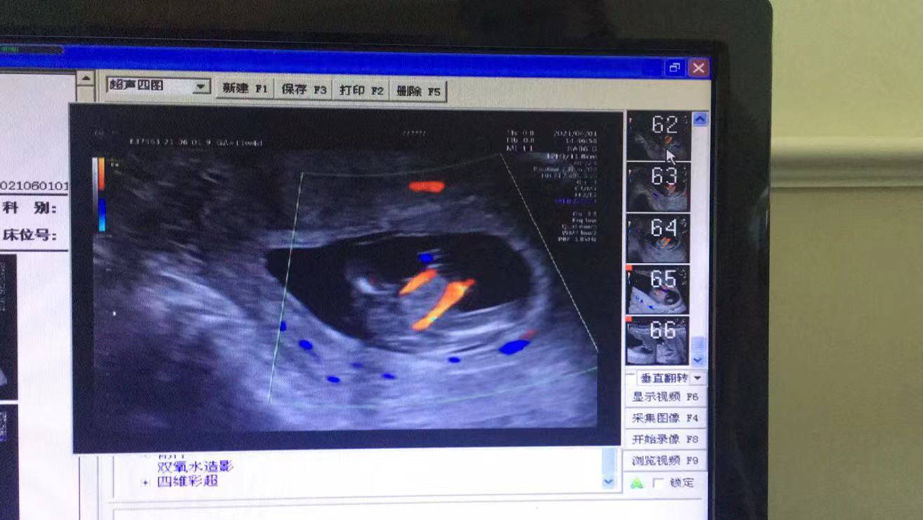 NT篩查出胎兒多發(fā)畸形，準媽媽無奈終止妊娠